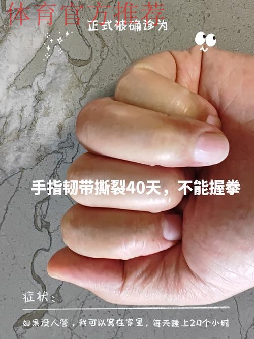 Siegel:康查尔左手拇指尺侧副韧带撕裂,三周后复查 Siegel:康查尔左手拇指尺侧副韧带撕裂,三周后复查